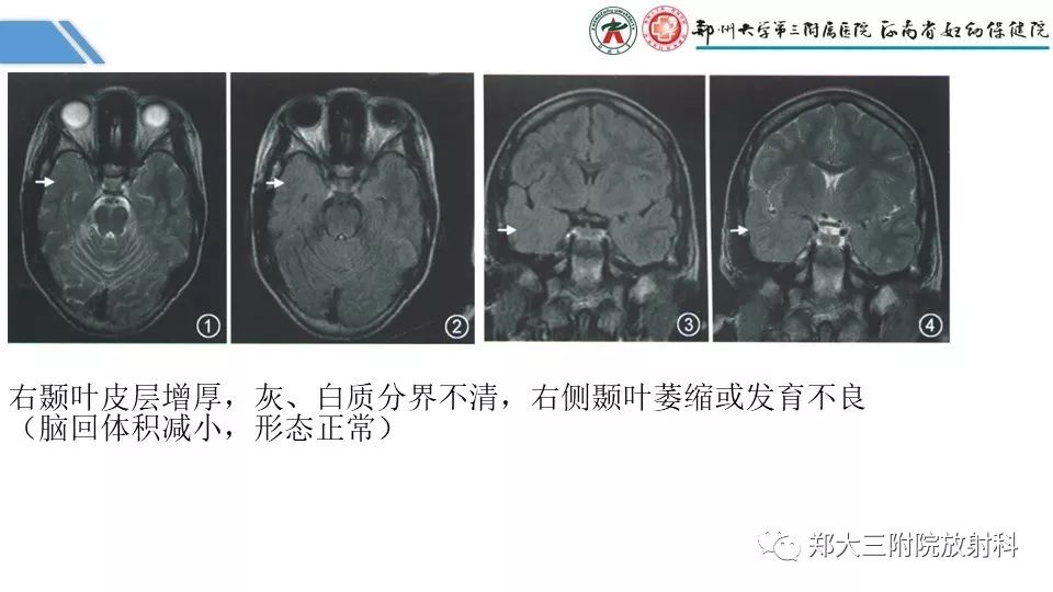 【PPT】局灶性脑皮层发育不良（FCD）
