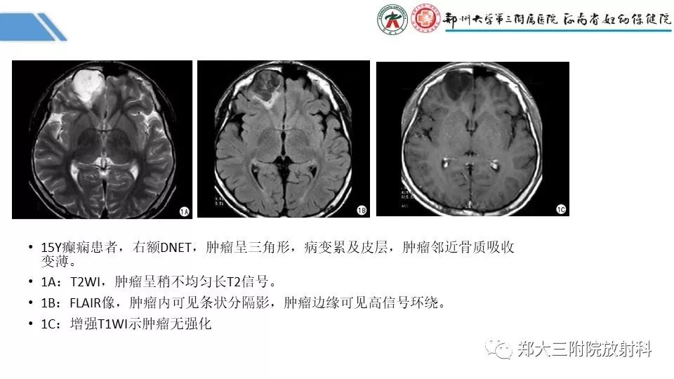 【PPT】局灶性脑皮层发育不良（FCD）