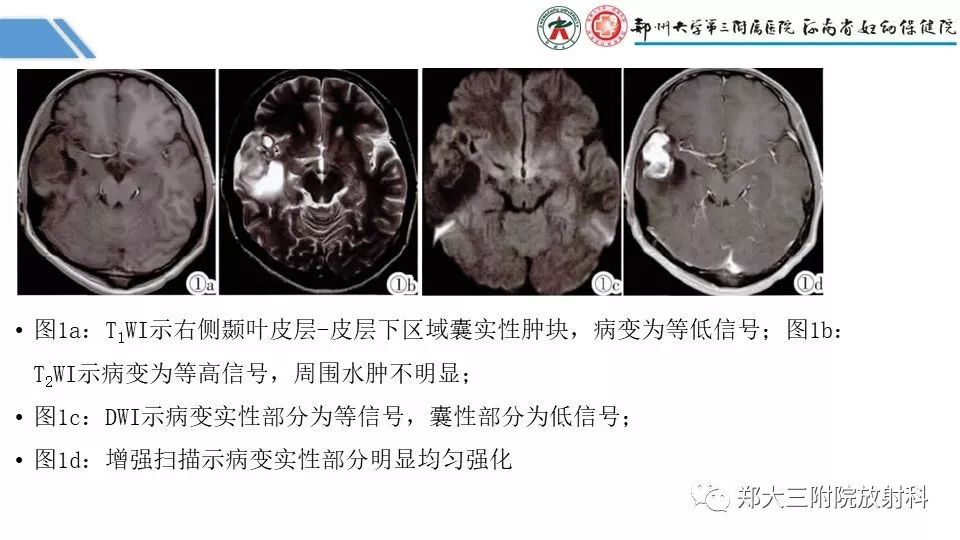 【PPT】局灶性脑皮层发育不良（FCD）