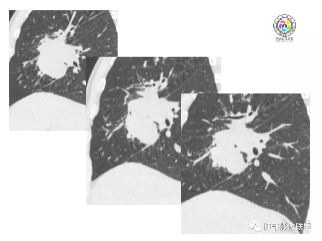 【病例】妖魔合体—你想不到的肉瘤样癌 【病例】妖魔合体—你想不到的肉瘤样癌