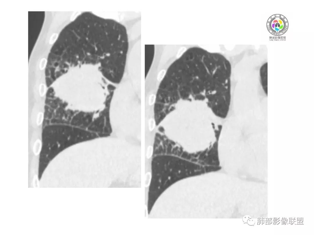【病例】妖魔合体—你想不到的肉瘤样癌 【病例】妖魔合体—你想不到的肉瘤样癌