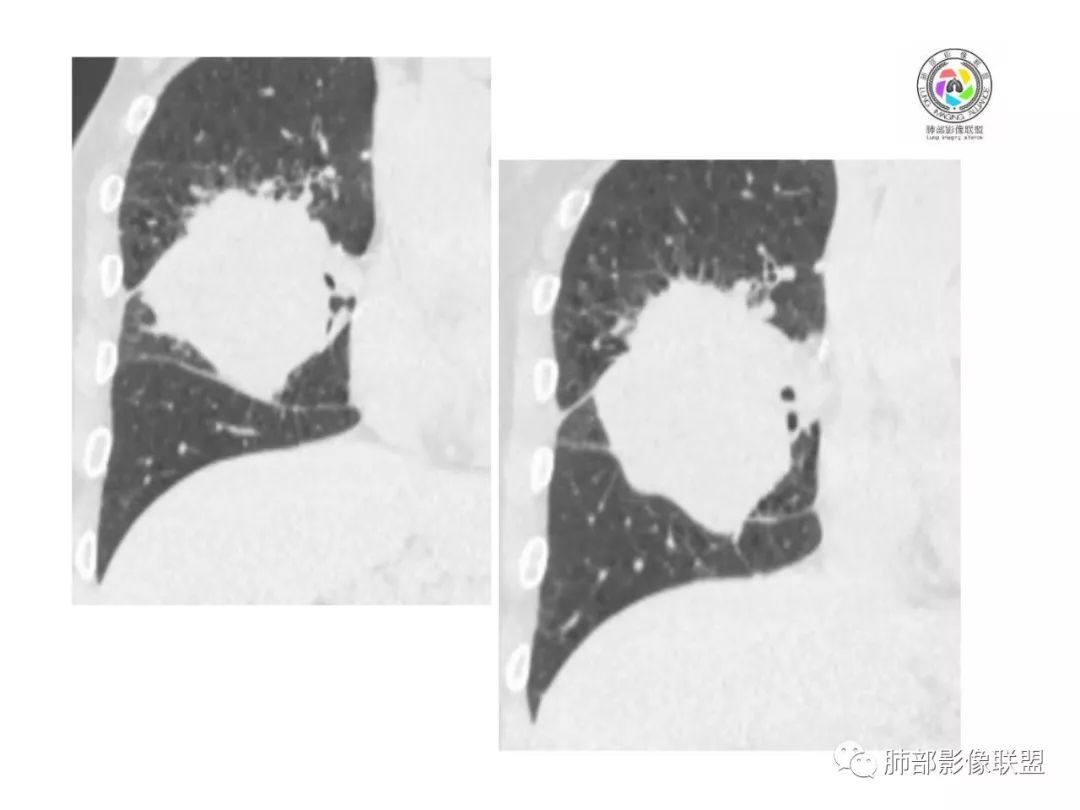 【病例】妖魔合体—你想不到的肉瘤样癌 【病例】妖魔合体—你想不到的肉瘤样癌