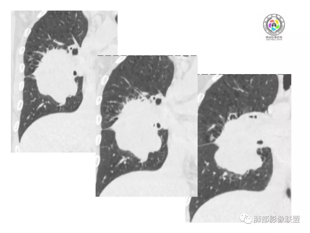【病例】妖魔合体—你想不到的肉瘤样癌 【病例】妖魔合体—你想不到的肉瘤样癌