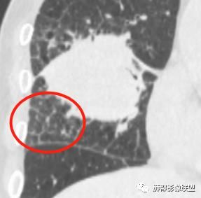 【病例】妖魔合体—你想不到的肉瘤样癌 【病例】妖魔合体—你想不到的肉瘤样癌