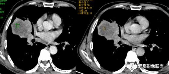 【病例】妖魔合体—你想不到的肉瘤样癌 【病例】妖魔合体—你想不到的肉瘤样癌