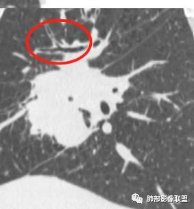【病例】妖魔合体—你想不到的肉瘤样癌 【病例】妖魔合体—你想不到的肉瘤样癌