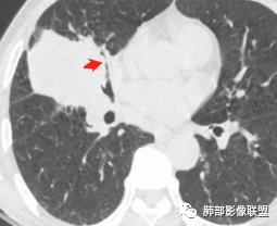【病例】妖魔合体—你想不到的肉瘤样癌 【病例】妖魔合体—你想不到的肉瘤样癌