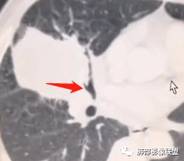 【病例】妖魔合体—你想不到的肉瘤样癌 【病例】妖魔合体—你想不到的肉瘤样癌