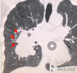 【病例】妖魔合体—你想不到的肉瘤样癌 【病例】妖魔合体—你想不到的肉瘤样癌