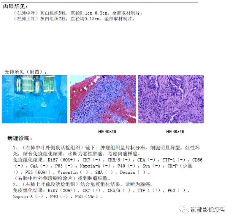 【病例】妖魔合体—你想不到的肉瘤样癌 【病例】妖魔合体—你想不到的肉瘤样癌