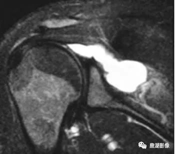 【病例】肩胛上神经卡压综合征1例MR 【病例】肩胛上神经卡压综合征1例MR