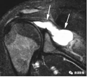 【病例】肩胛上神经卡压综合征1例MR 【病例】肩胛上神经卡压综合征1例MR