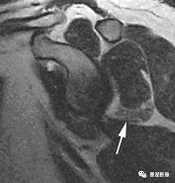 【病例】肩胛上神经卡压综合征1例MR 【病例】肩胛上神经卡压综合征1例MR