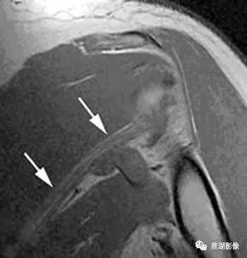 【病例】肩胛上神经卡压综合征1例MR 【病例】肩胛上神经卡压综合征1例MR