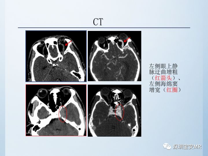 【病例】颈动脉海绵窦瘘3例CT及MR影像