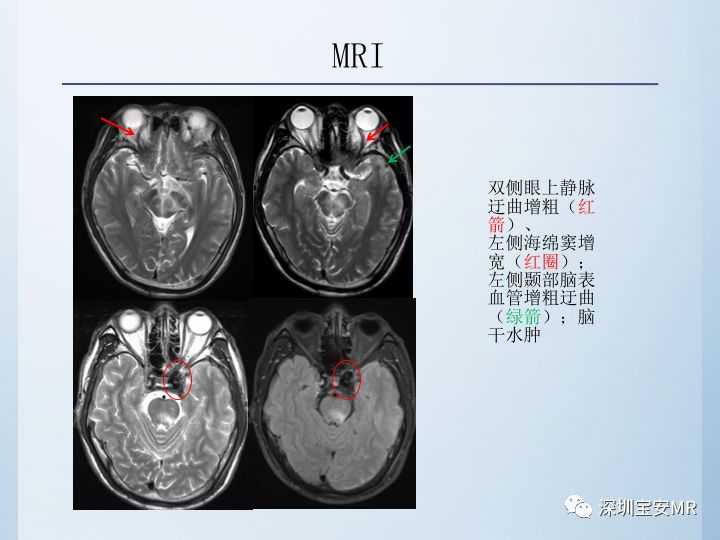 【病例】颈动脉海绵窦瘘3例CT及MR影像
