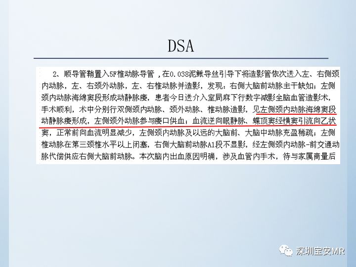 【病例】颈动脉海绵窦瘘3例CT及MR影像
