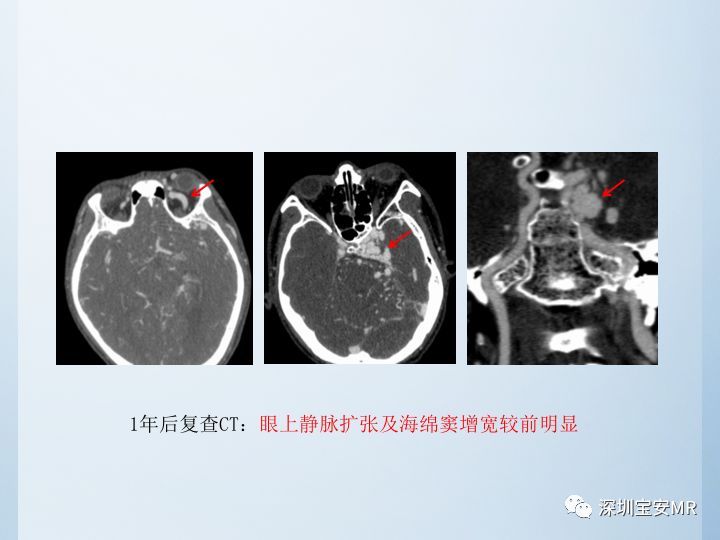 【病例】颈动脉海绵窦瘘3例CT及MR影像