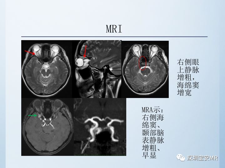 【病例】颈动脉海绵窦瘘3例CT及MR影像