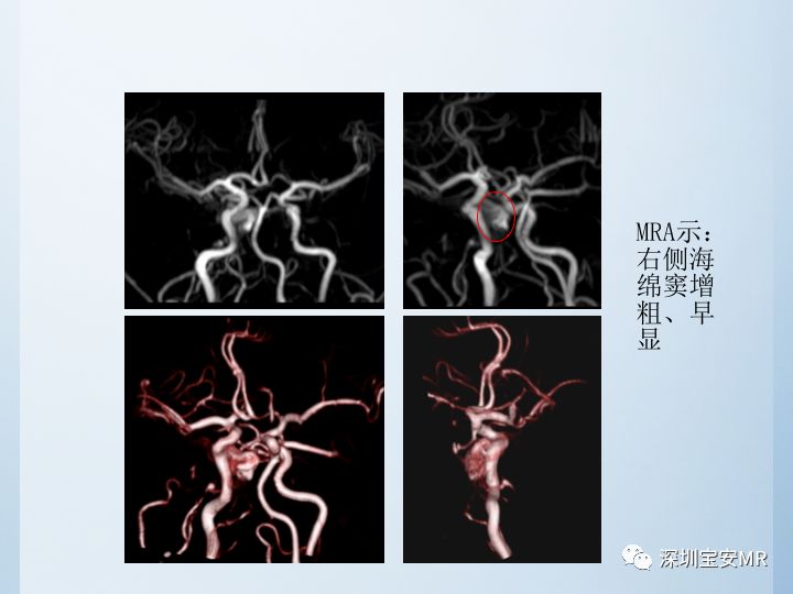 【病例】颈动脉海绵窦瘘3例CT及MR影像