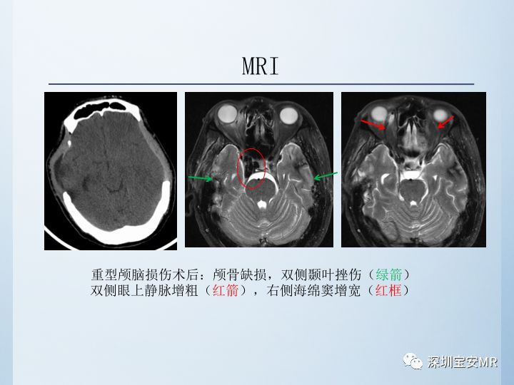 【病例】颈动脉海绵窦瘘3例CT及MR影像