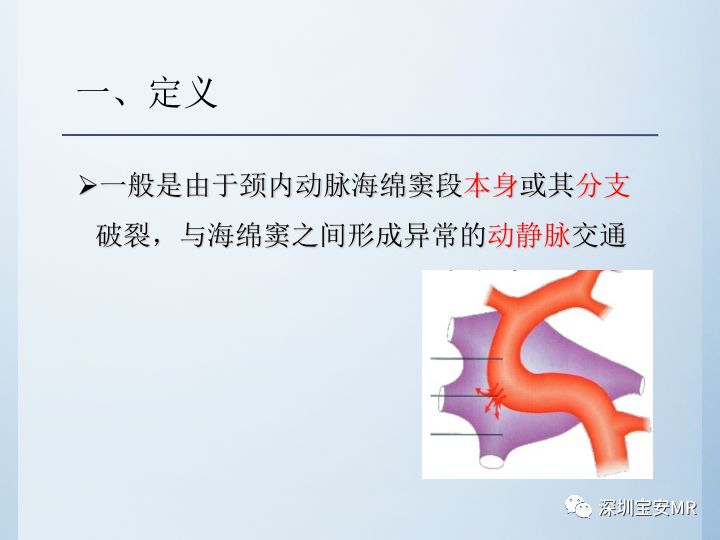 【病例】颈动脉海绵窦瘘3例CT及MR影像