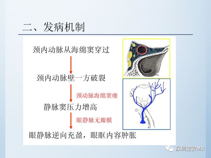 【病例】颈动脉海绵窦瘘3例CT及MR影像