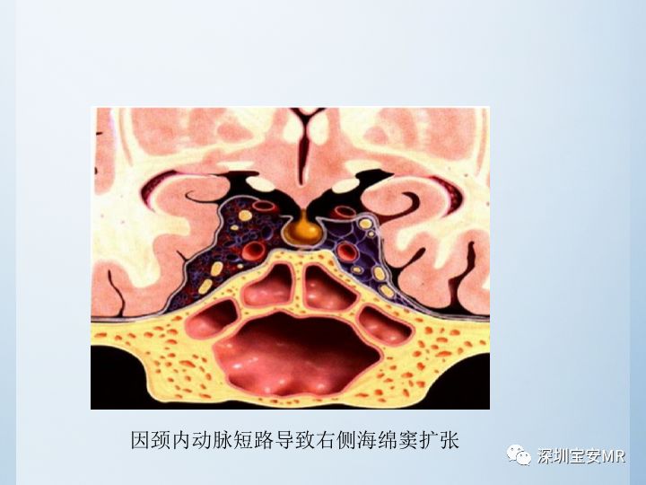 【病例】颈动脉海绵窦瘘3例CT及MR影像