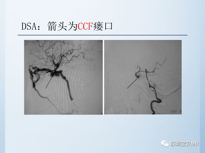 【病例】颈动脉海绵窦瘘3例CT及MR影像