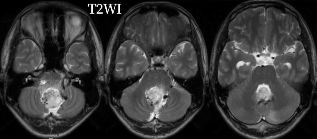 血管母细胞瘤 MRI 表现 血管母细胞瘤 MRI 表现