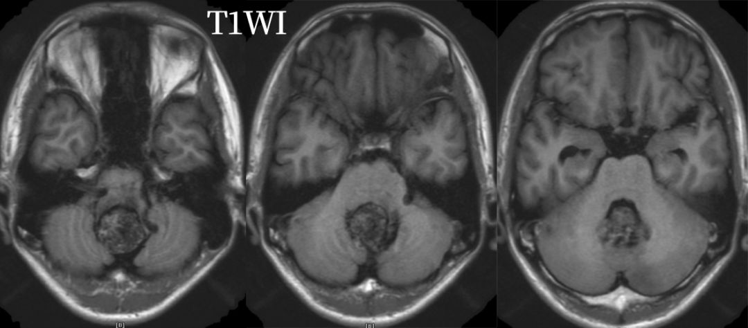 血管母细胞瘤 MRI 表现 血管母细胞瘤 MRI 表现