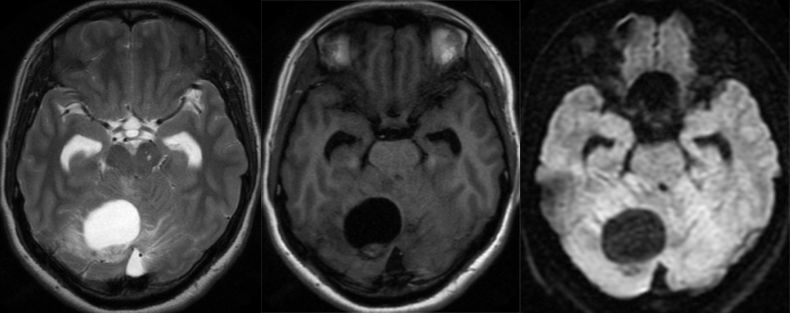 血管母细胞瘤 MRI 表现 血管母细胞瘤 MRI 表现