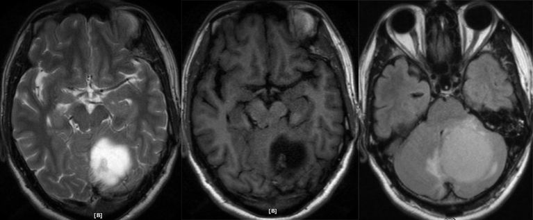 血管母细胞瘤 MRI 表现 血管母细胞瘤 MRI 表现