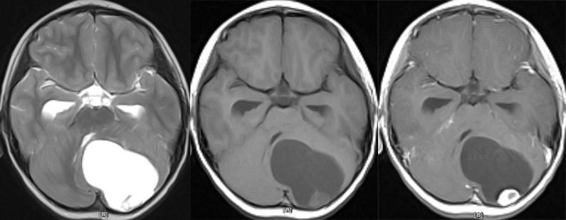 血管母细胞瘤 MRI 表现 血管母细胞瘤 MRI 表现