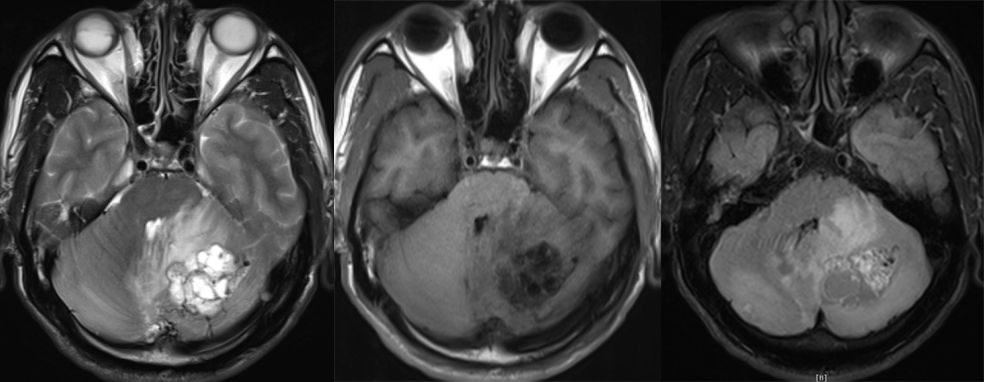 血管母细胞瘤 MRI 表现 血管母细胞瘤 MRI 表现