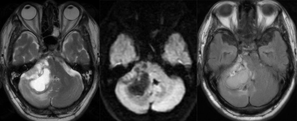 血管母细胞瘤 MRI 表现 血管母细胞瘤 MRI 表现