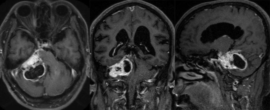 血管母细胞瘤 MRI 表现 血管母细胞瘤 MRI 表现