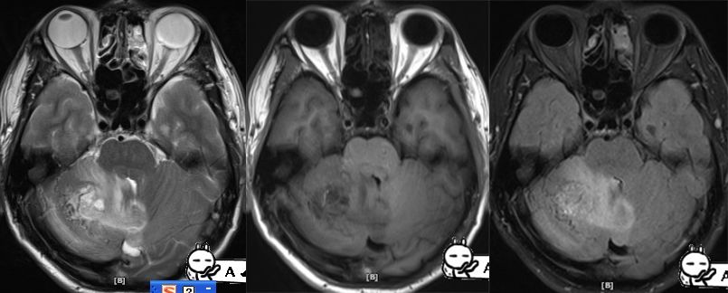 血管母细胞瘤 MRI 表现 血管母细胞瘤 MRI 表现
