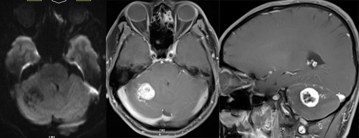 血管母细胞瘤 MRI 表现 血管母细胞瘤 MRI 表现