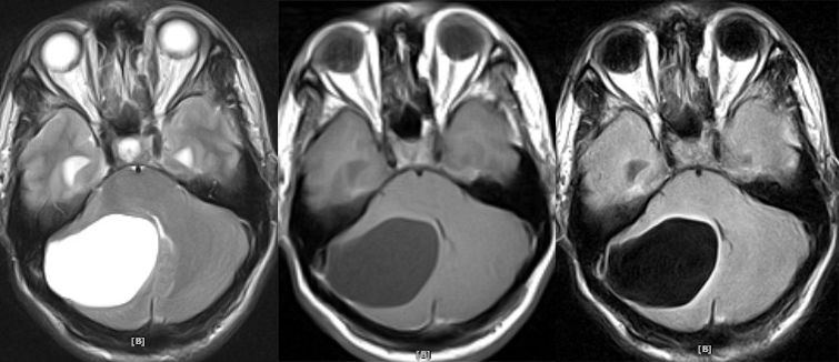 血管母细胞瘤 MRI 表现 血管母细胞瘤 MRI 表现