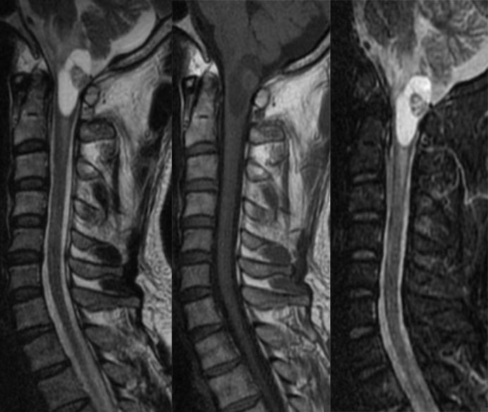 血管母细胞瘤 MRI 表现 血管母细胞瘤 MRI 表现