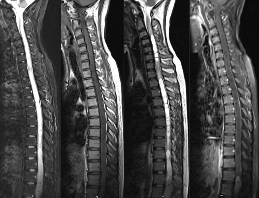 血管母细胞瘤 MRI 表现 血管母细胞瘤 MRI 表现
