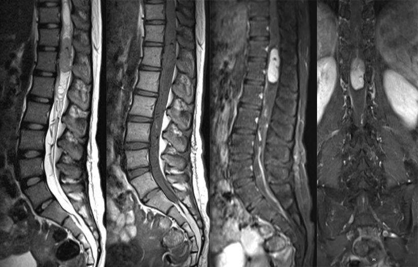 血管母细胞瘤 MRI 表现 血管母细胞瘤 MRI 表现