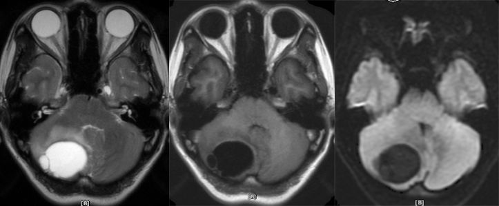 血管母细胞瘤 MRI 表现 血管母细胞瘤 MRI 表现