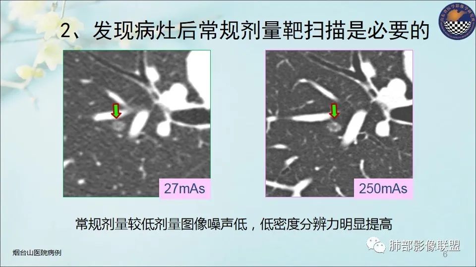 【PPT】重视针对肺GGO的战略转移