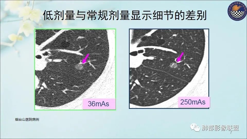 【PPT】重视针对肺GGO的战略转移