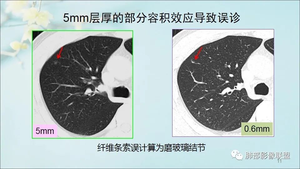 【PPT】重视针对肺GGO的战略转移