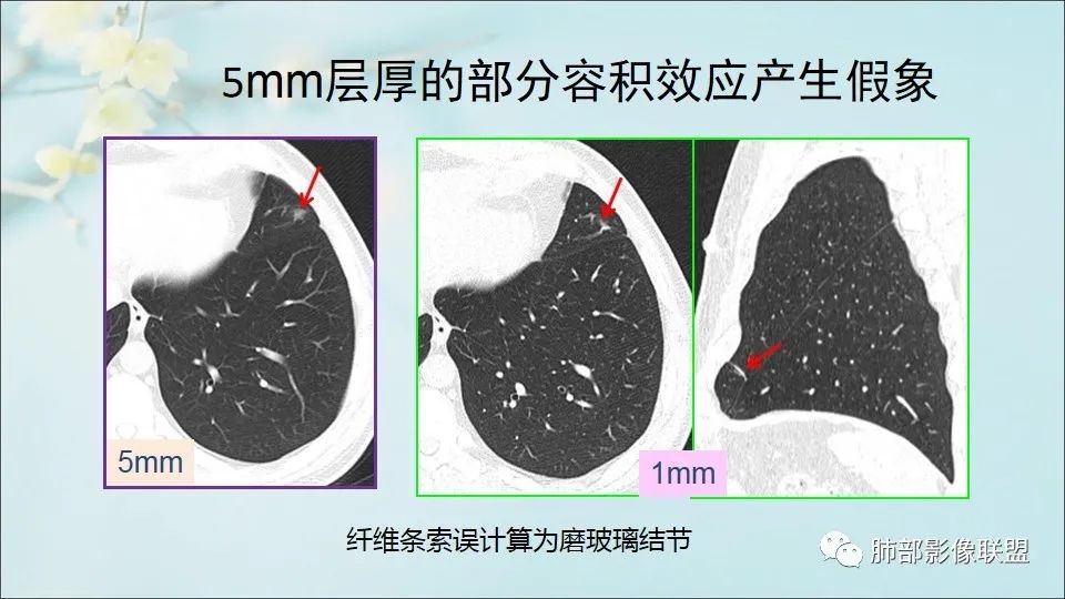 【PPT】重视针对肺GGO的战略转移