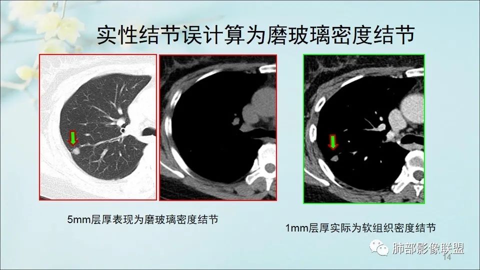 【PPT】重视针对肺GGO的战略转移