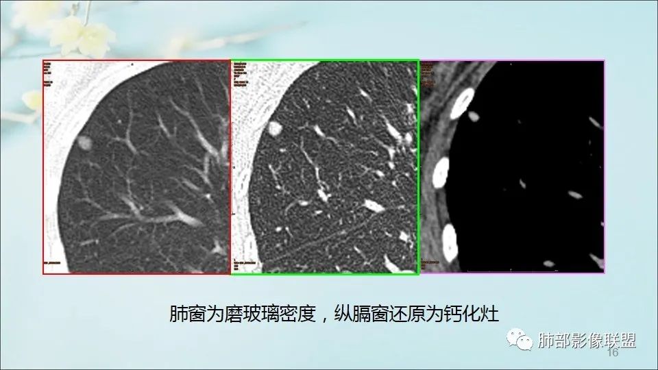 【PPT】重视针对肺GGO的战略转移